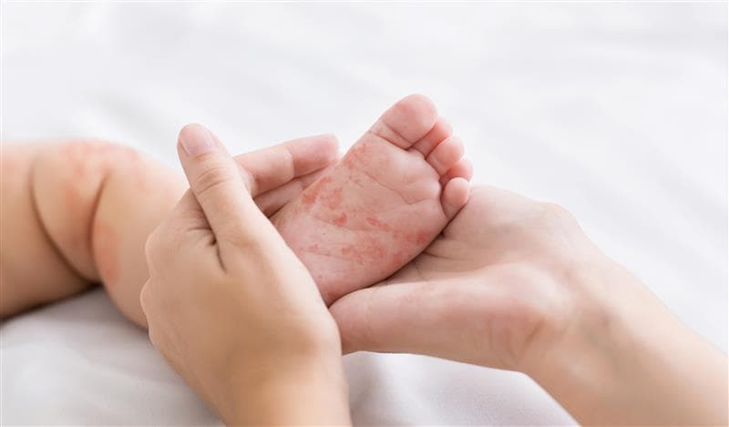 What to know about increased cases of measles in the US