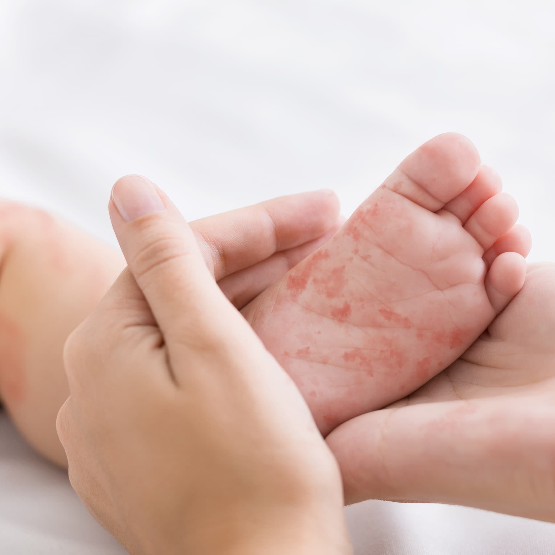 What to know about the measles 